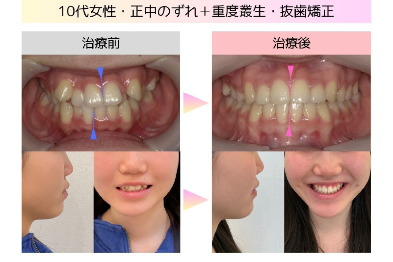 交叉咬合症例