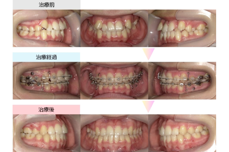 交叉咬合症例