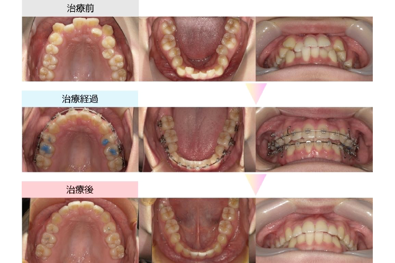 交叉咬合症例