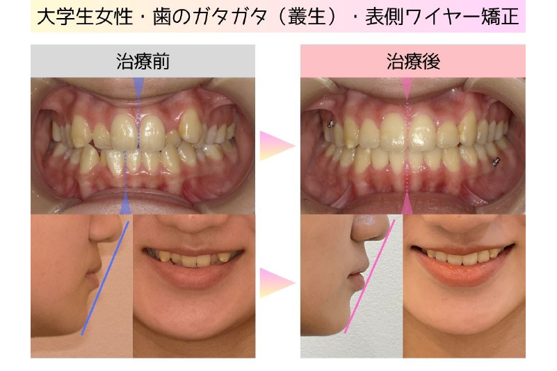 叢生症例
