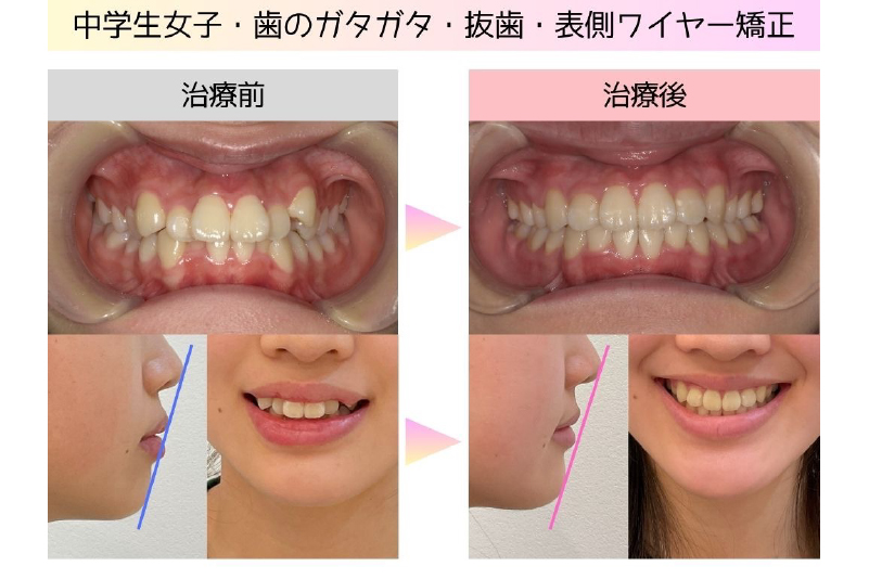 叢生症例