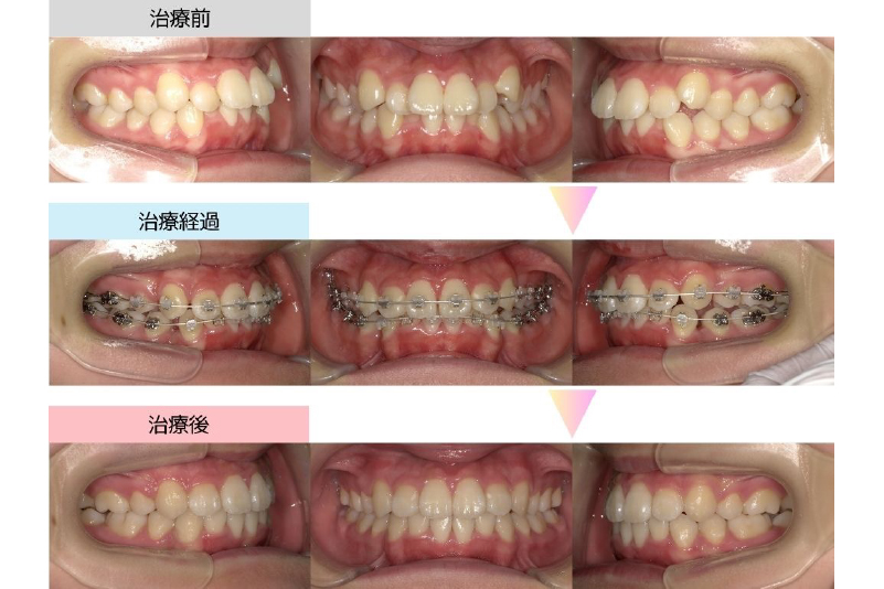 叢生症例