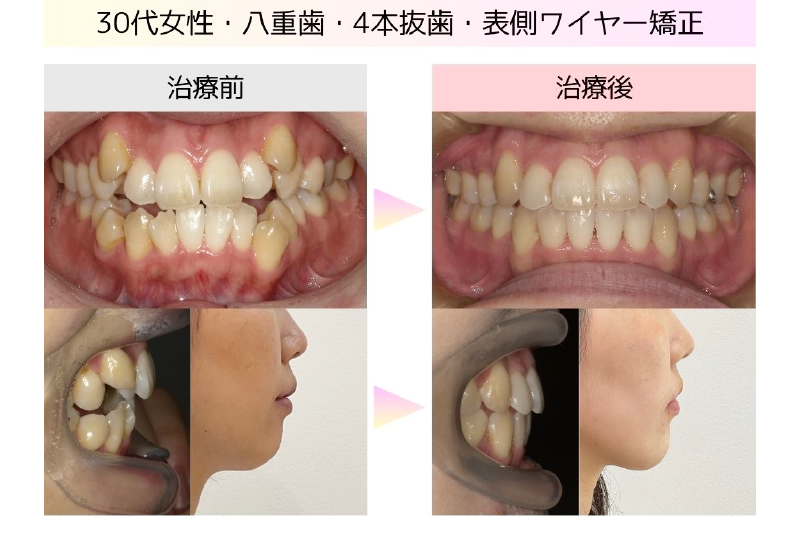 叢生症例