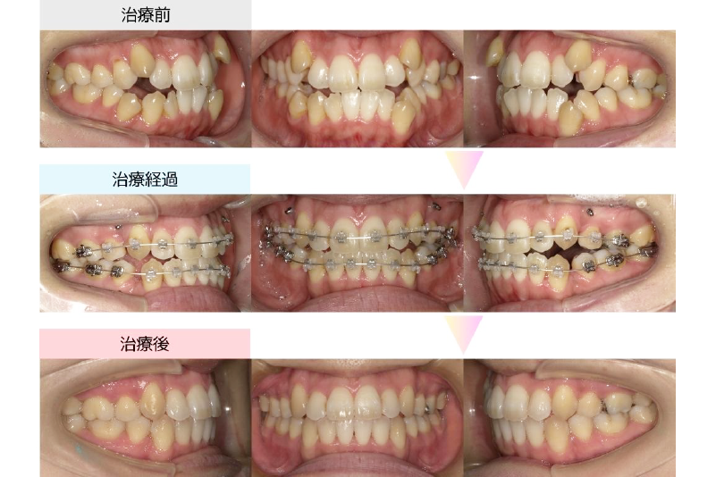 叢生症例