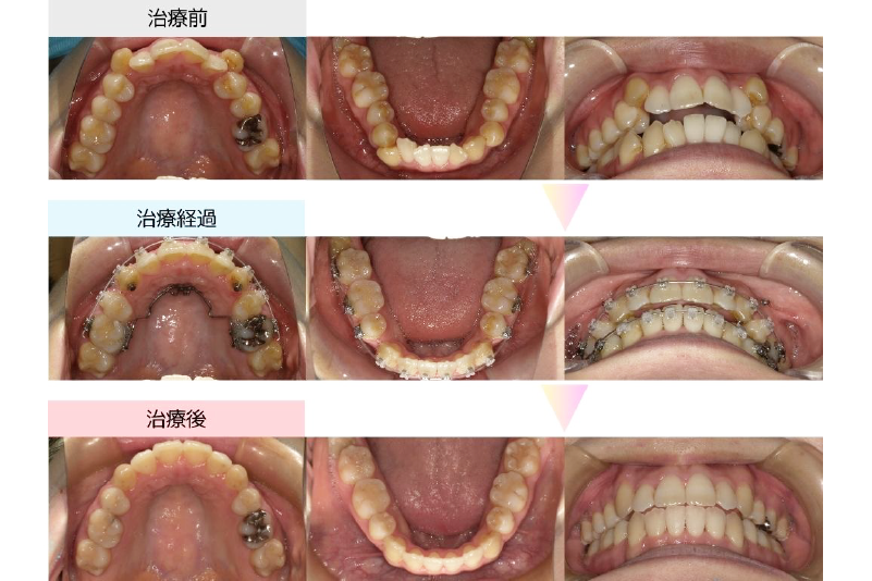 叢生症例