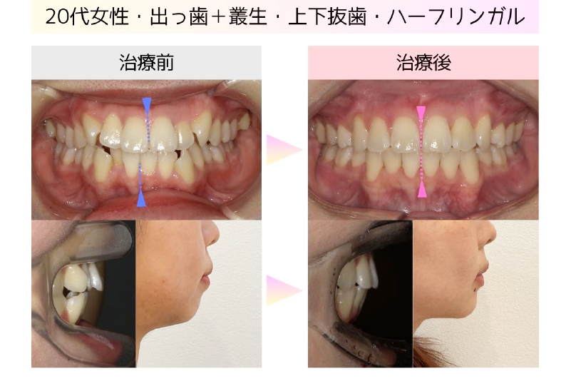 叢生症例