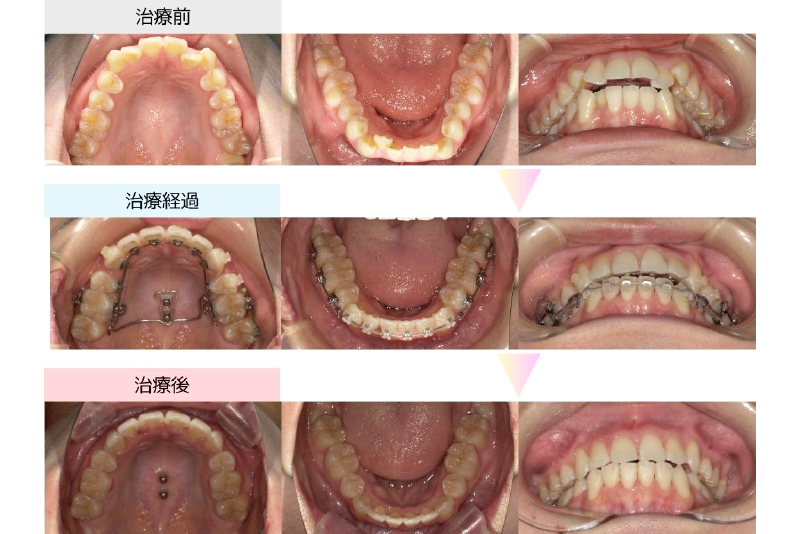 叢生症例
