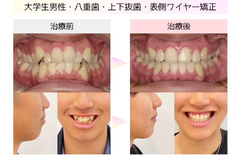 叢生症例
