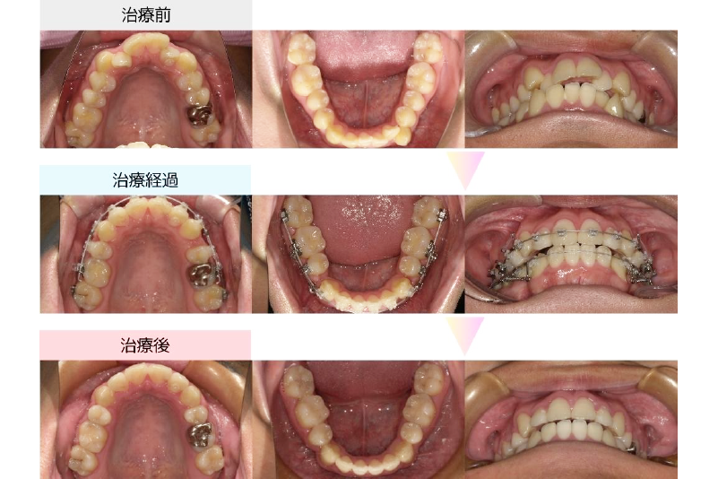 叢生症例