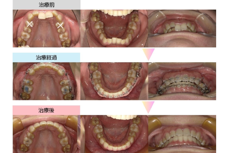 過蓋咬合症例