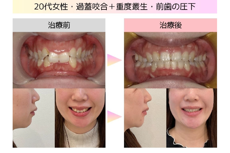 過蓋咬合症例