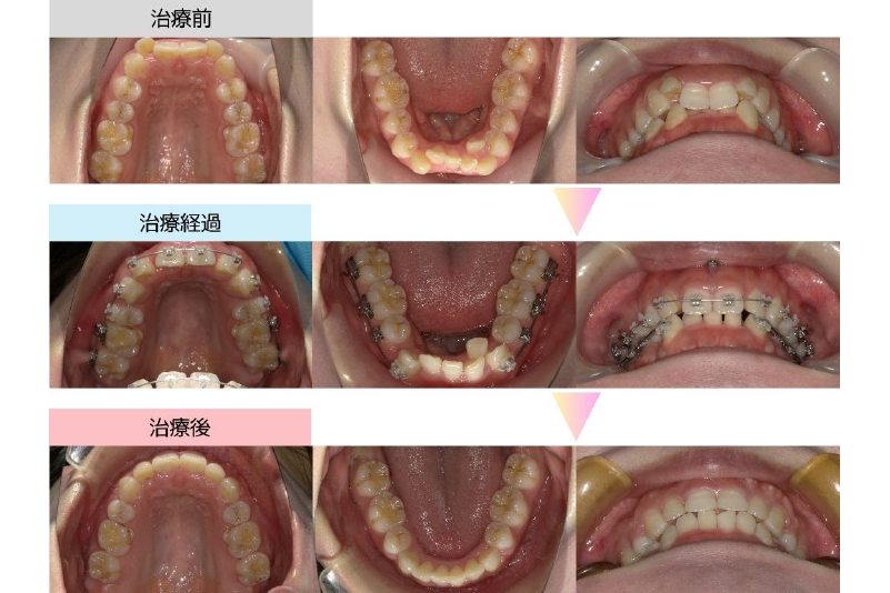 過蓋咬合症例