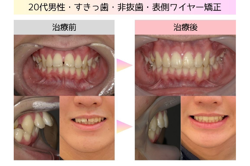 すきっ歯症例