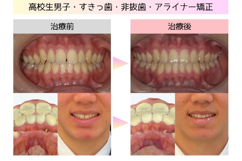 すきっ歯症例