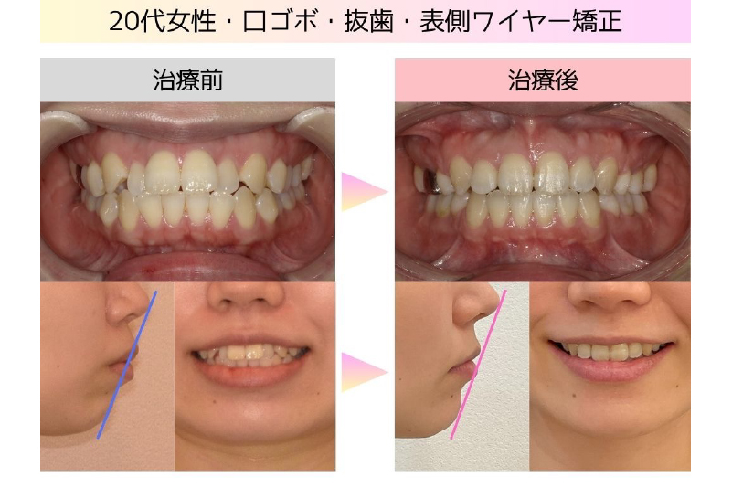 口ゴボ症例