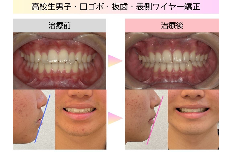 口ゴボ症例