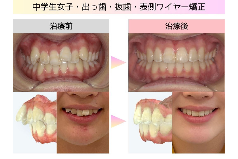 出っ歯症例