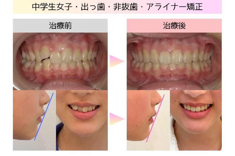 出っ歯症例