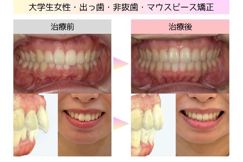 出っ歯症例