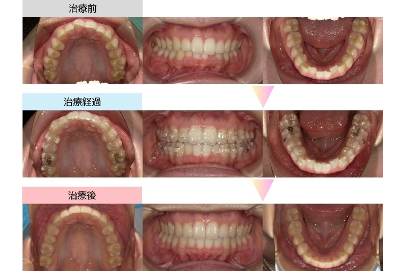 出っ歯症例