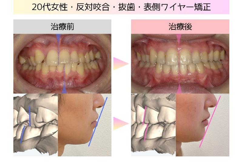 叢生症例
