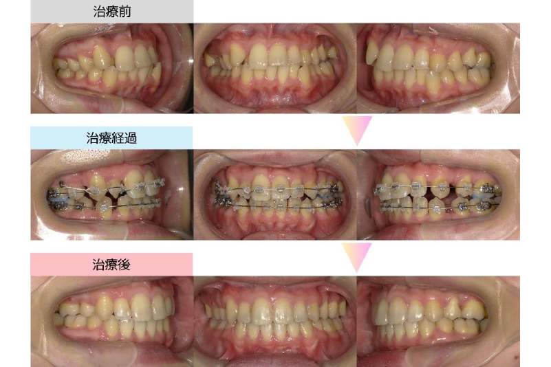 叢生症例