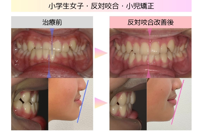 反対咬合症例