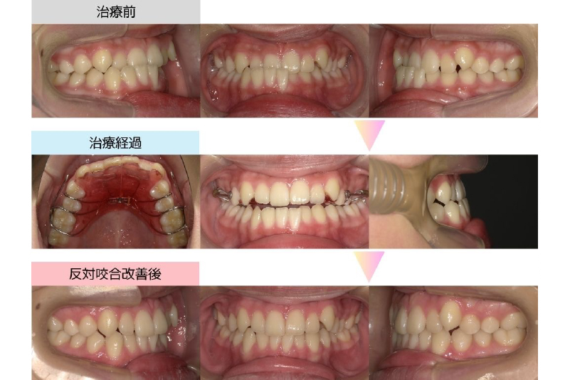反対咬合症例